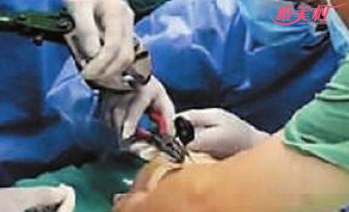 2歲女童眉骨戳進剪刀 兇險經過曝光女童疼痛到已麻木 2