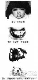 歌舞伎面譜綜合癥小女孩 為什么會長得漂亮？ 2