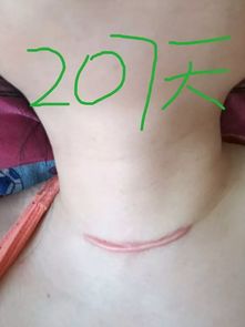 朱迅甲狀腺癌是全切嗎 4