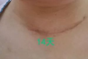 朱迅甲狀腺癌是全切嗎