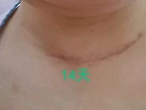 朱迅甲狀腺癌是全切嗎 1