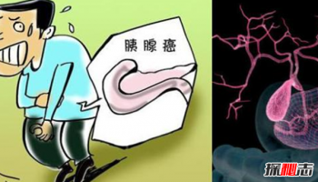 李詠得了什么癌癥 李詠為什么治不好 5