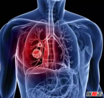 李詠得了什么癌癥 李詠為什么治不好 10